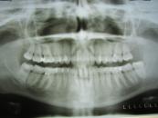 dental versicherung